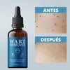 Wart Remover - Removedor de verrugas y lunares